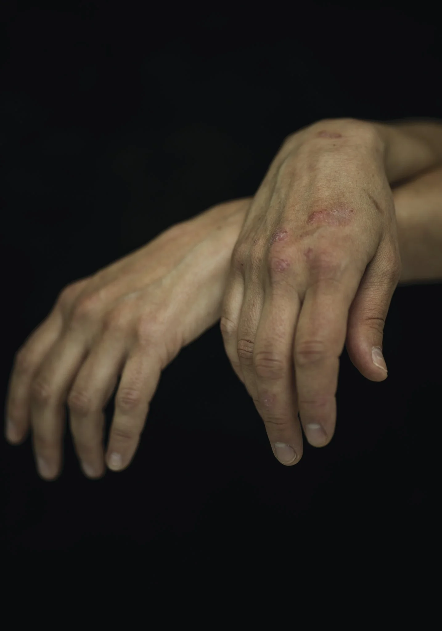 DRIANNA CZECHOWICZ
“My hands don’t look like that.” I have slender hands and long fingers. In addition to AS, I have psoriatic arthritis, which caused my nails to come off and made my fingers look swollen and knobby.
“That swollen, crooked finger isn