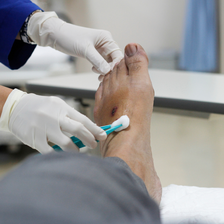 Clinician debriding a wound on a patient’s foot with a sterile instrument