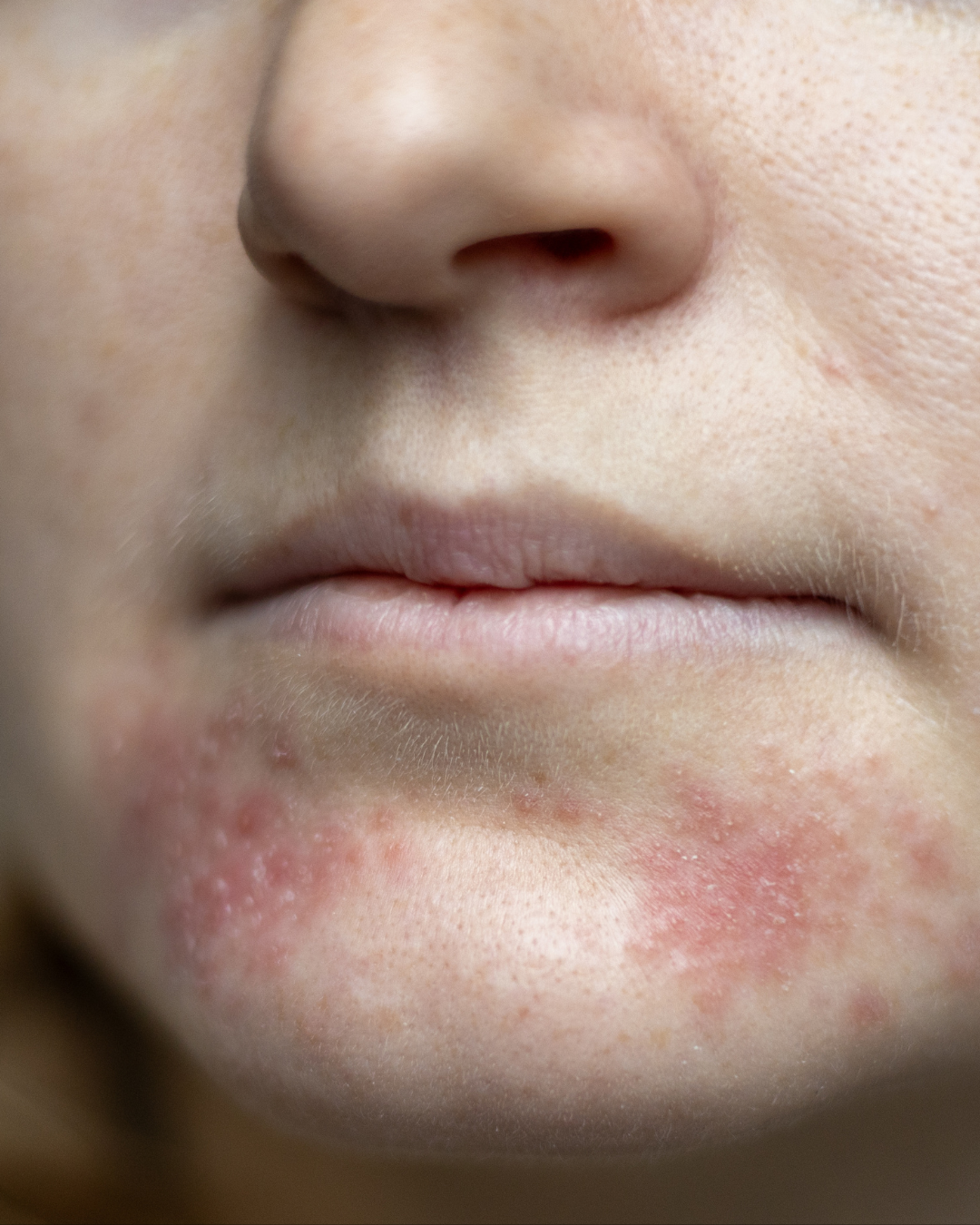 Perioral Dermatitis: symptoms, triggers, and treatment
