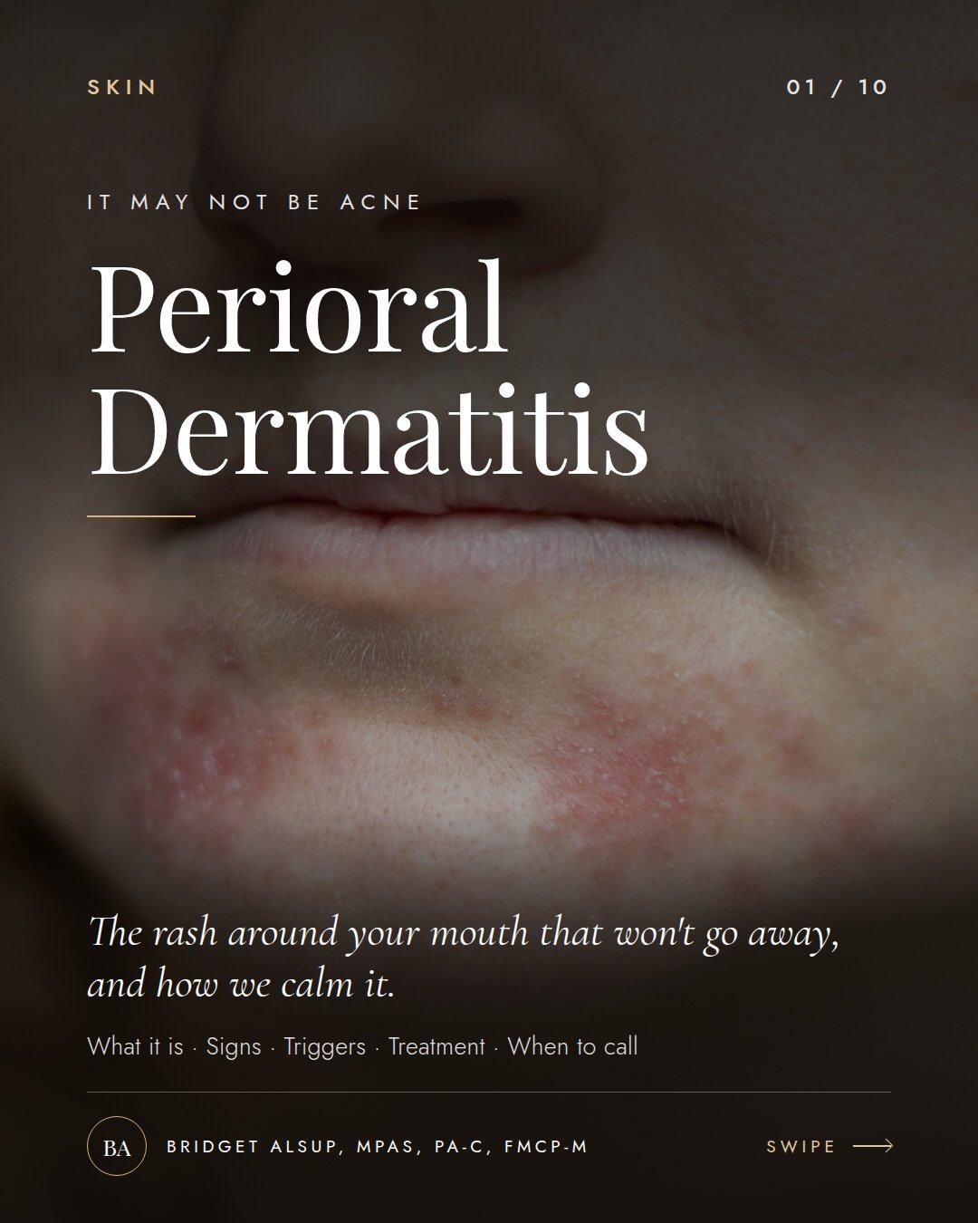 That rash around your mouth that won&rsquo;t go away is not always acne.

Perioral dermatitis (POD) is one of the most common things I see that gets mistaken for a breakout. Small red or pink bumps, dry flaky patches, a little burning or stinging, us