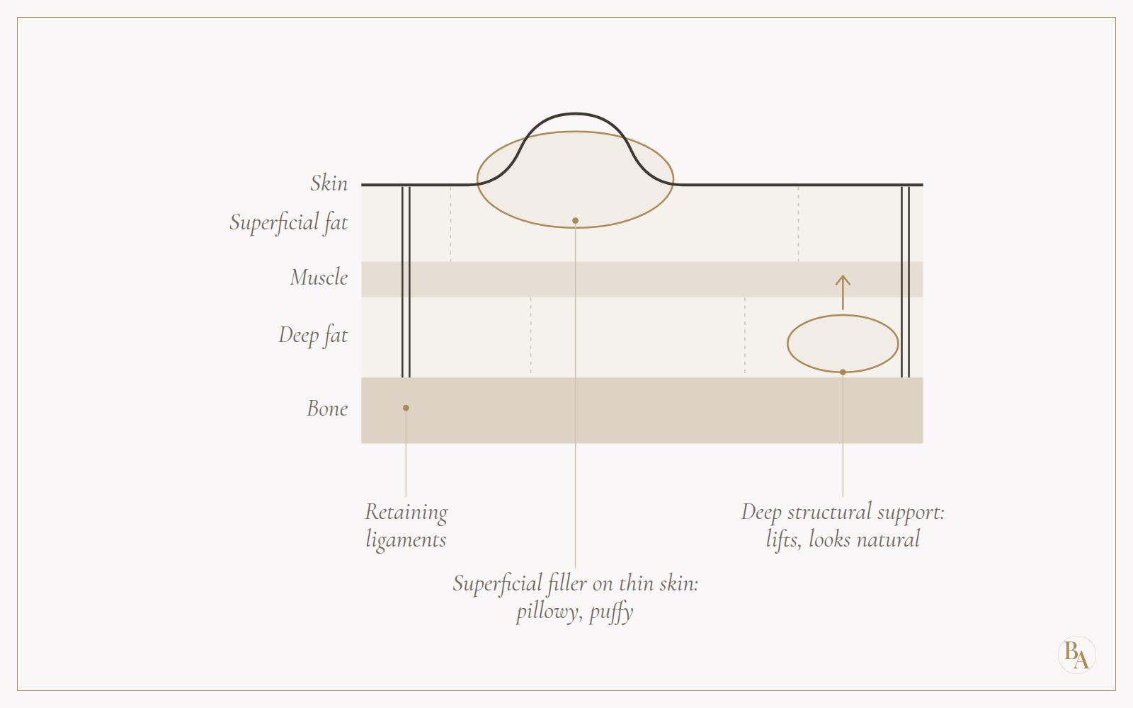 Cross-section of facial layers (skin, superficial fat, muscle, deep fat and bone) with retaining ligaments, comparing superficial filler that bulges the skin with deep filler that lifts from underneath.
