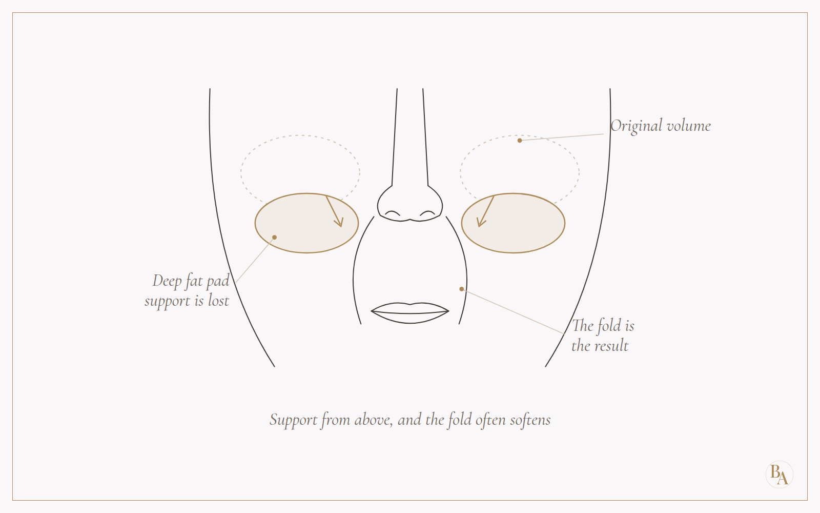 Front view of the midface showing deflated deep cheek fat pads below their original volume, and the nasolabial folds as the result.