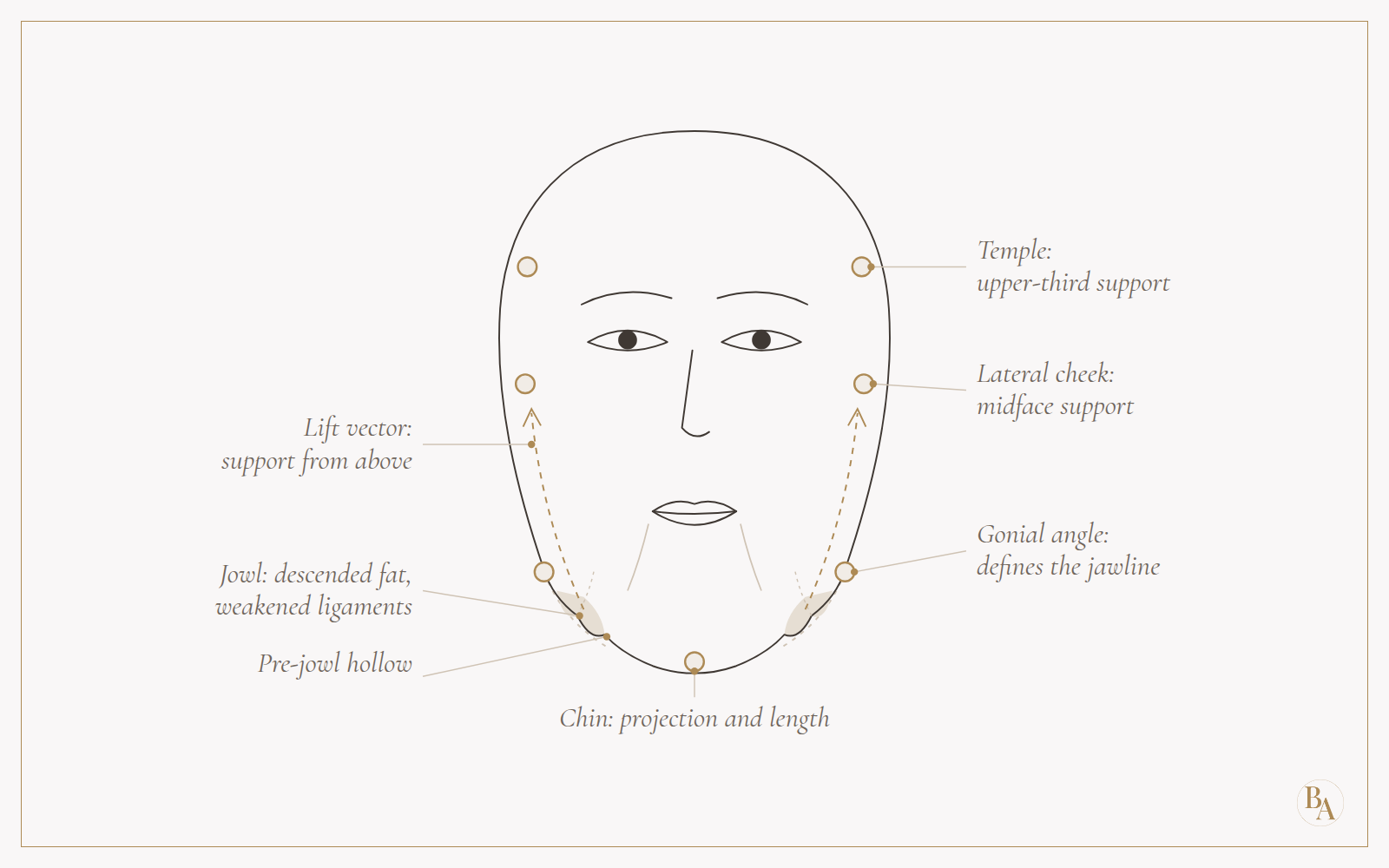 Front view of a face with gold markers at the temples, outer cheeks, angles of the jaw and chin, dashed upward arrows from the jowls toward the cheeks, and shaded jowls sitting below a faint outline of the smooth jawline.