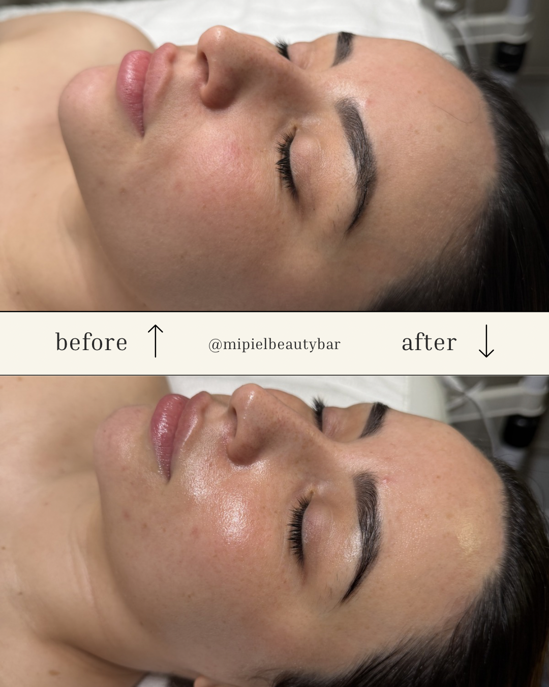 Before-and-after facial skincare results at Mi Piel Beauty Bar in Beltsville, MD.