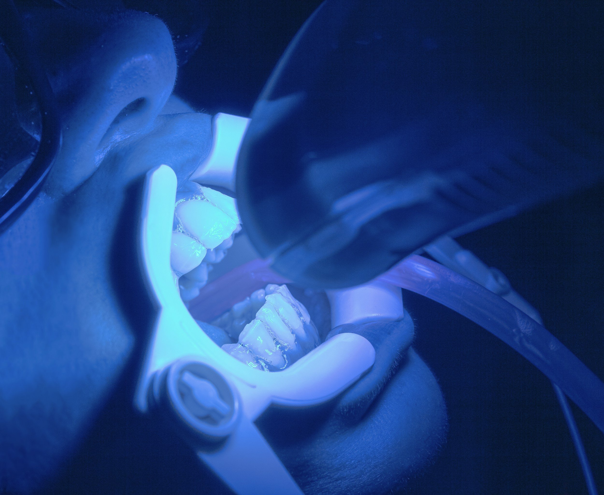 Close-up of a dental impression mold made of blue material with a partial denture or dental appliance within it, illuminated by blue light.