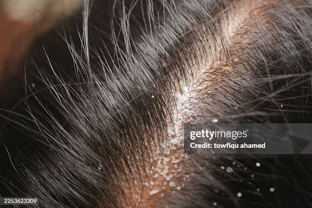 Close-up of a person's scalp with hair and white dandruff flakes.