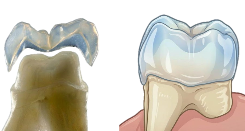 Darstellung eines Zahnes, bestehend aus einer echten Zahnkrone und einer Dentalprothese.