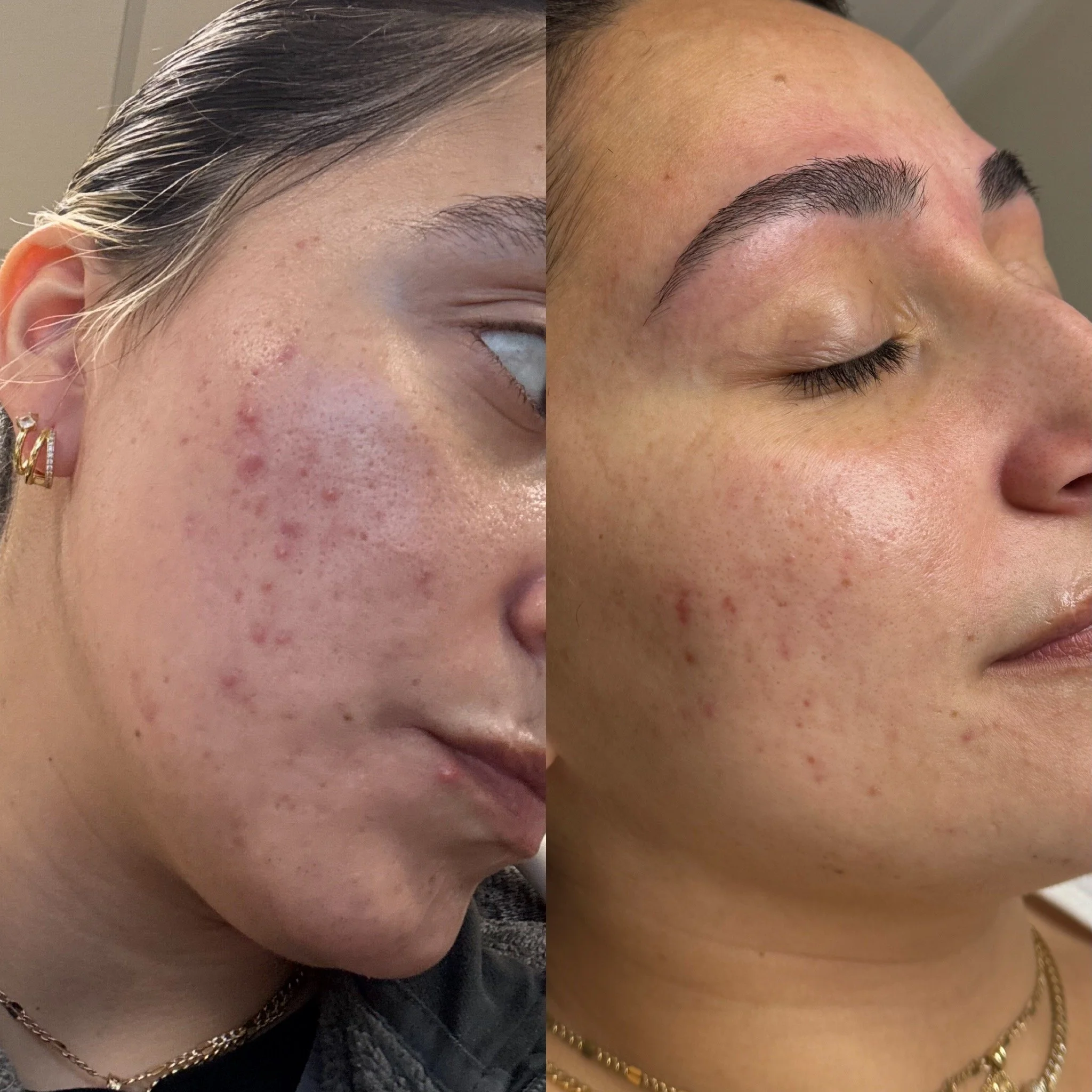 Acne and transformative facial before and after results in Union, NJ