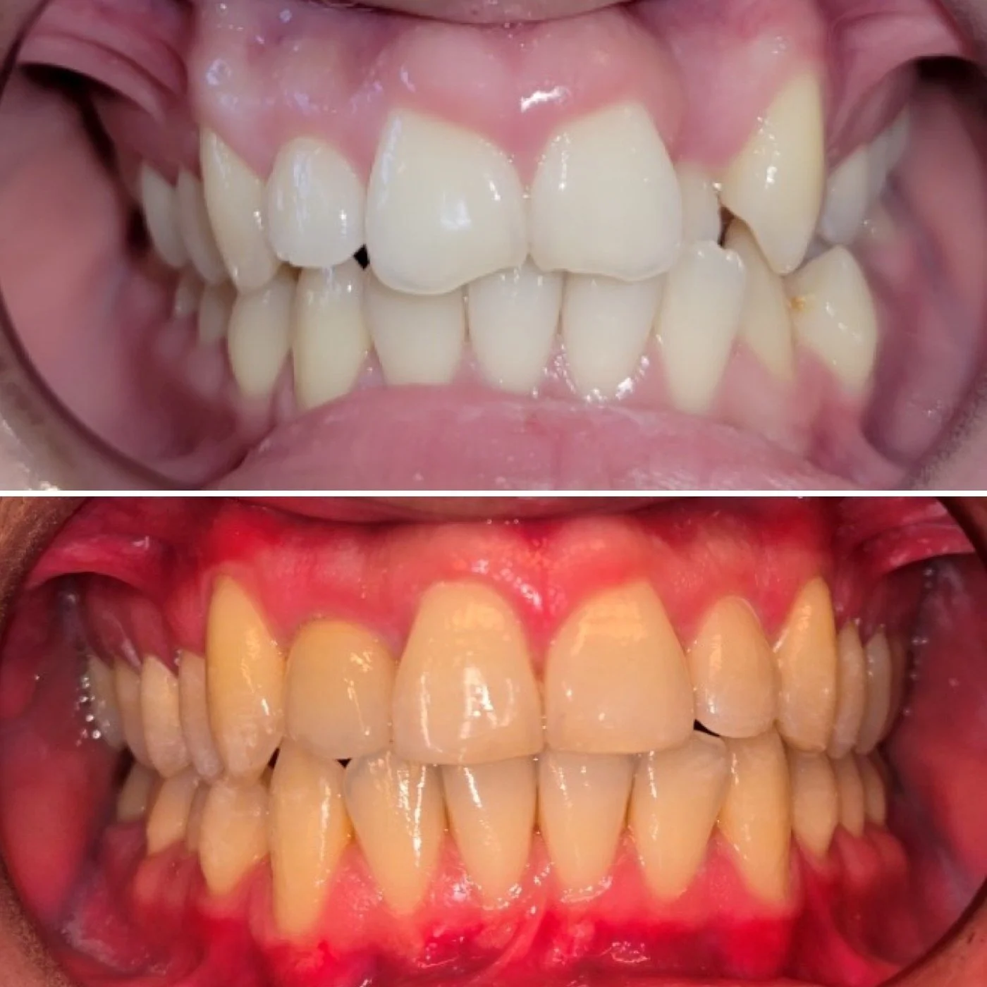 Before and after orthodontic treatment for an anterior crossbite.