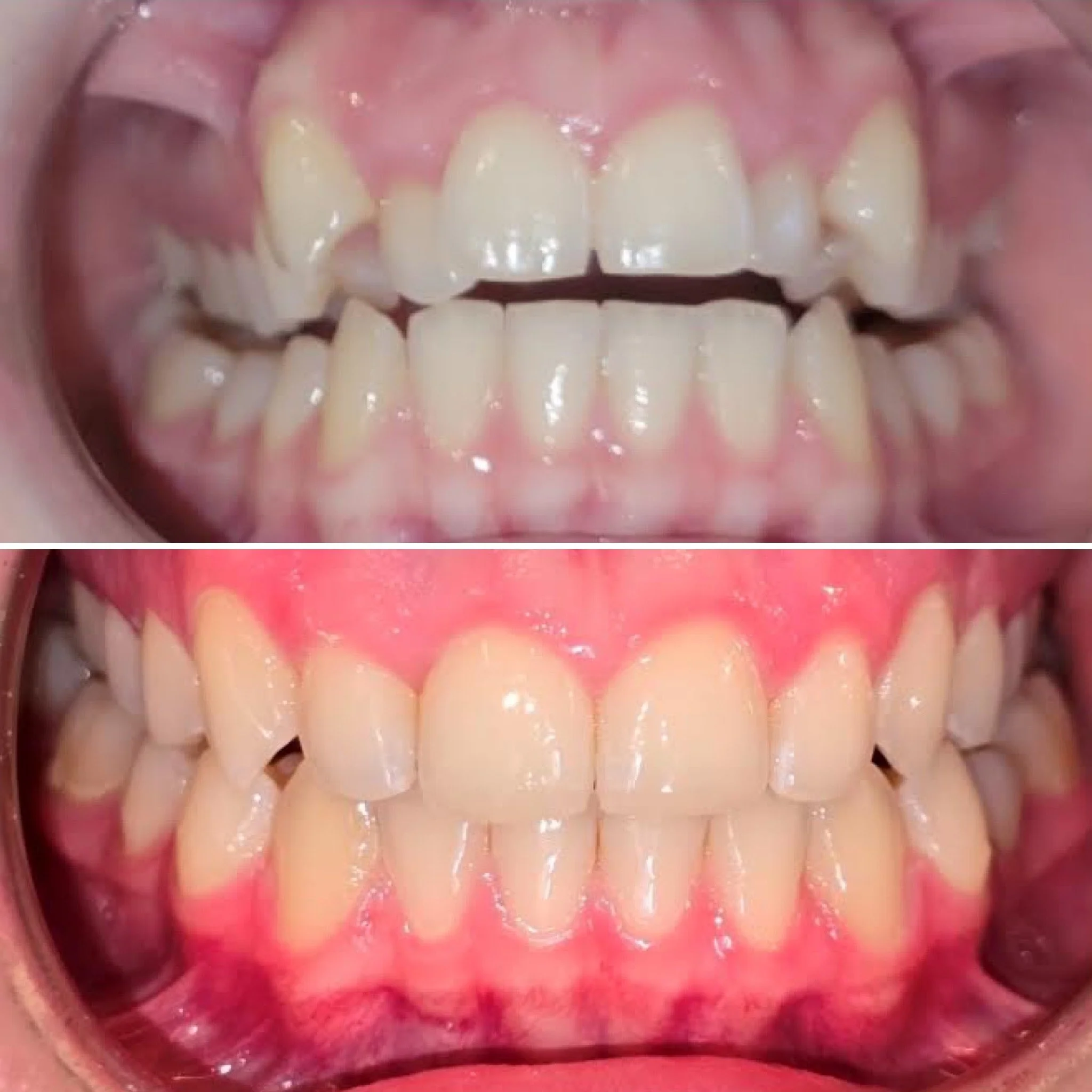 Before and after orthodontic treatment for a posterior crossbite.
