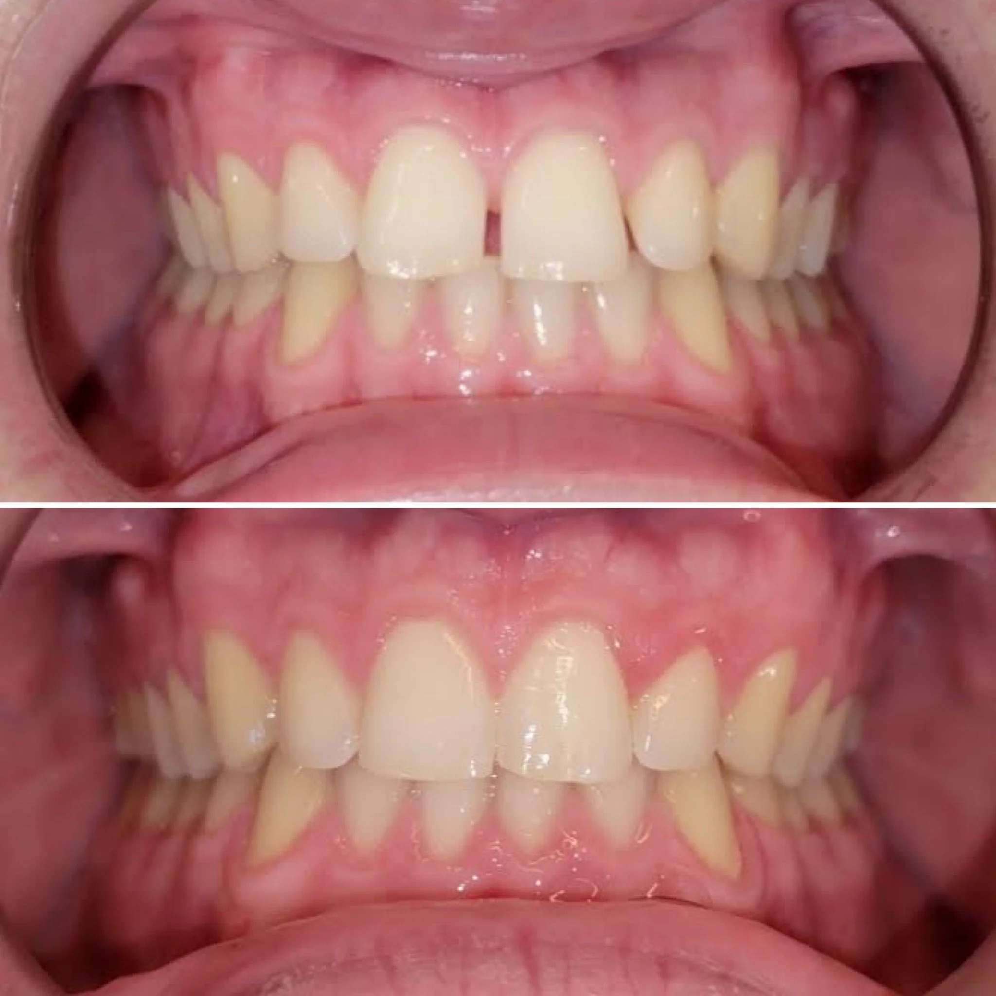 Before and after orthodontic treatment for spacing and gaps between the front teeth.