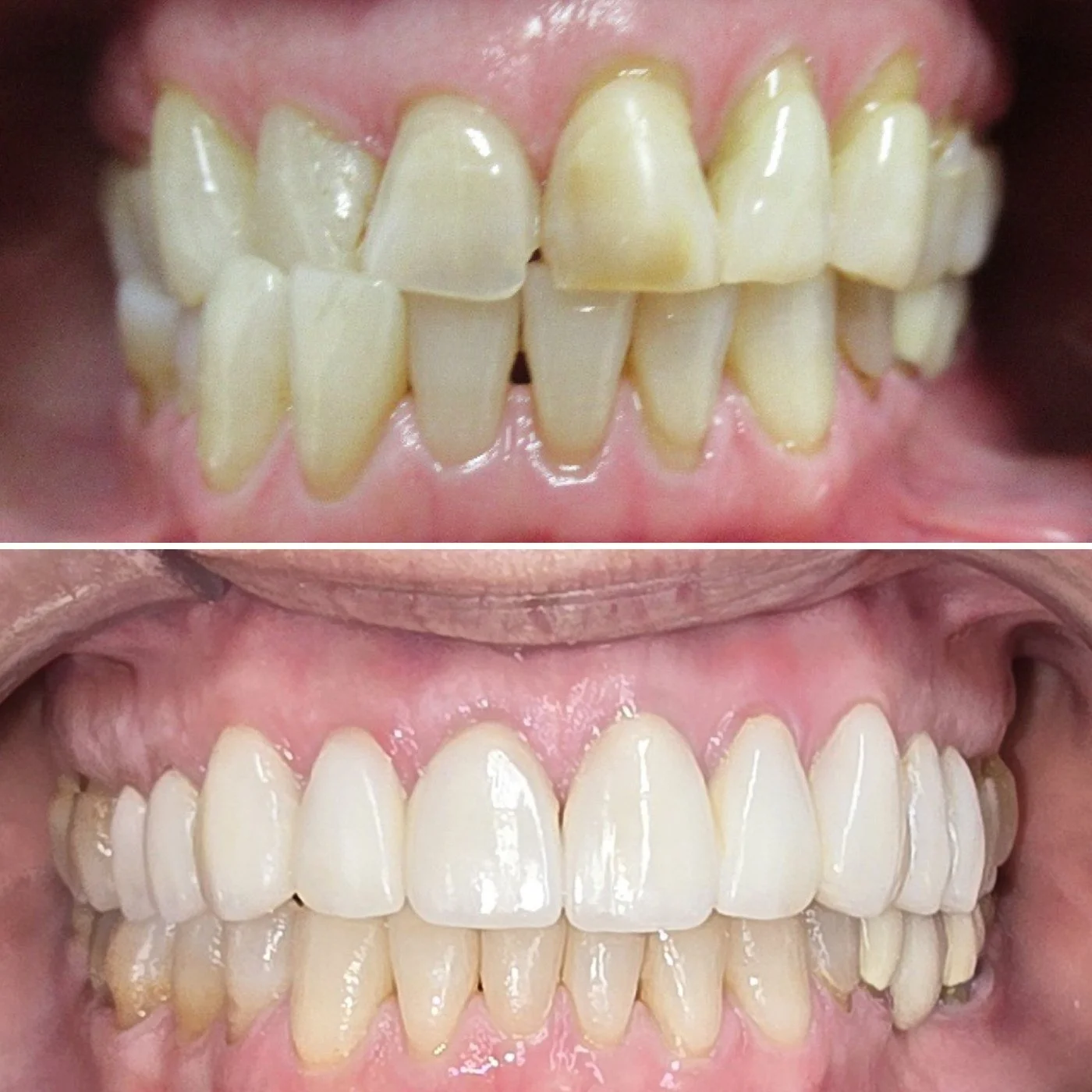 Before and after orthodontic treatment for crowded teeth.