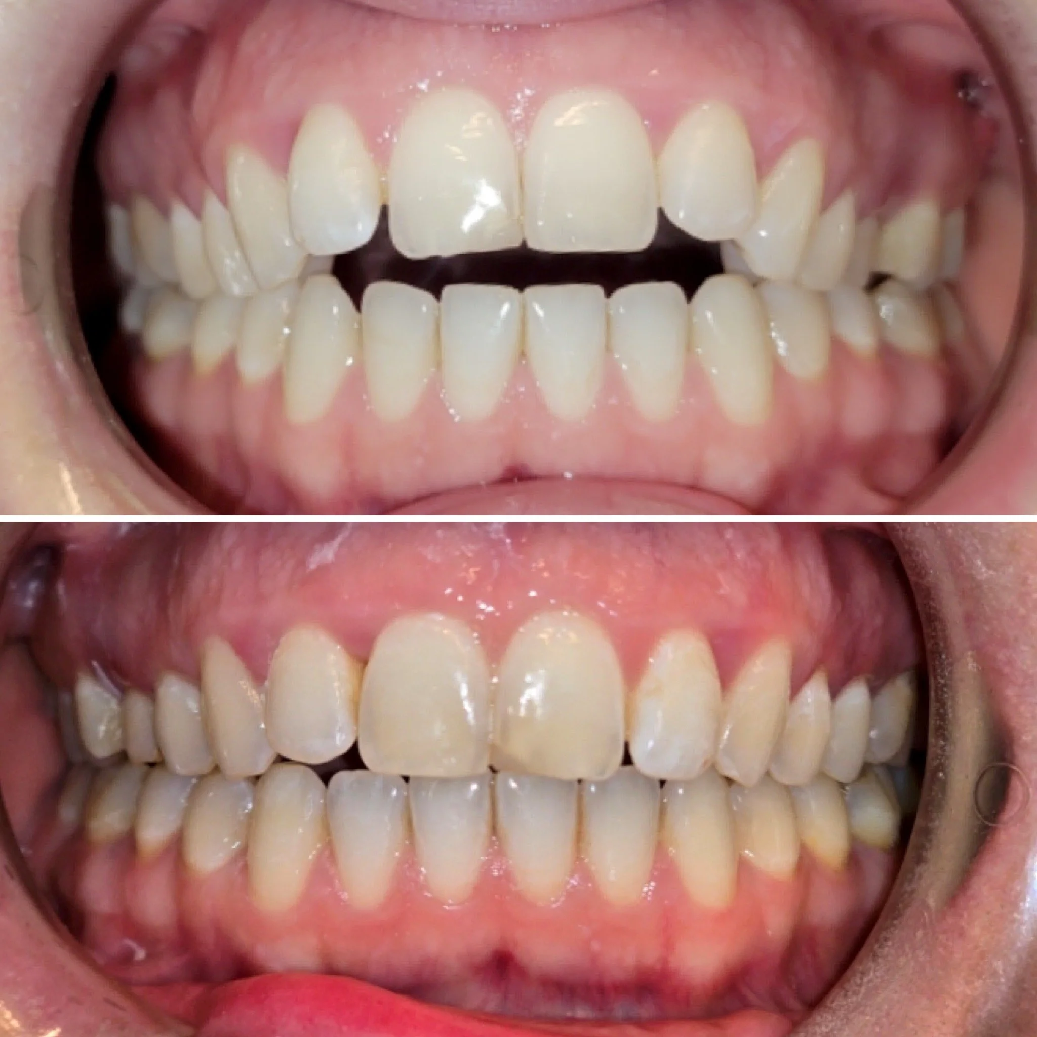 Before and after orthodontic treatment for an open bite.