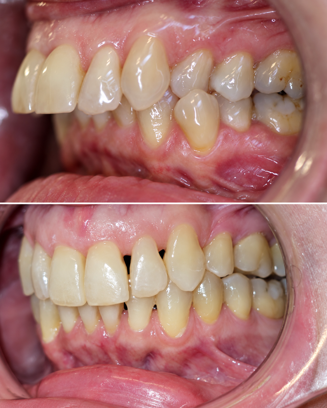 Before and after orthodontic treatment for overbite