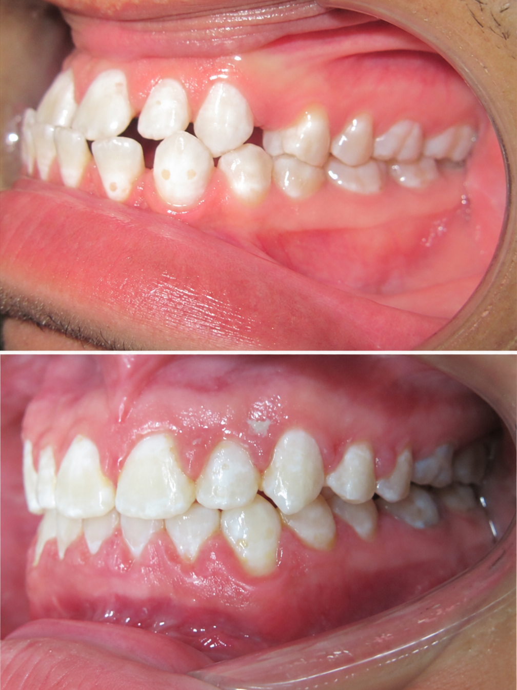 Before and after orthodontic treatment for underbite
