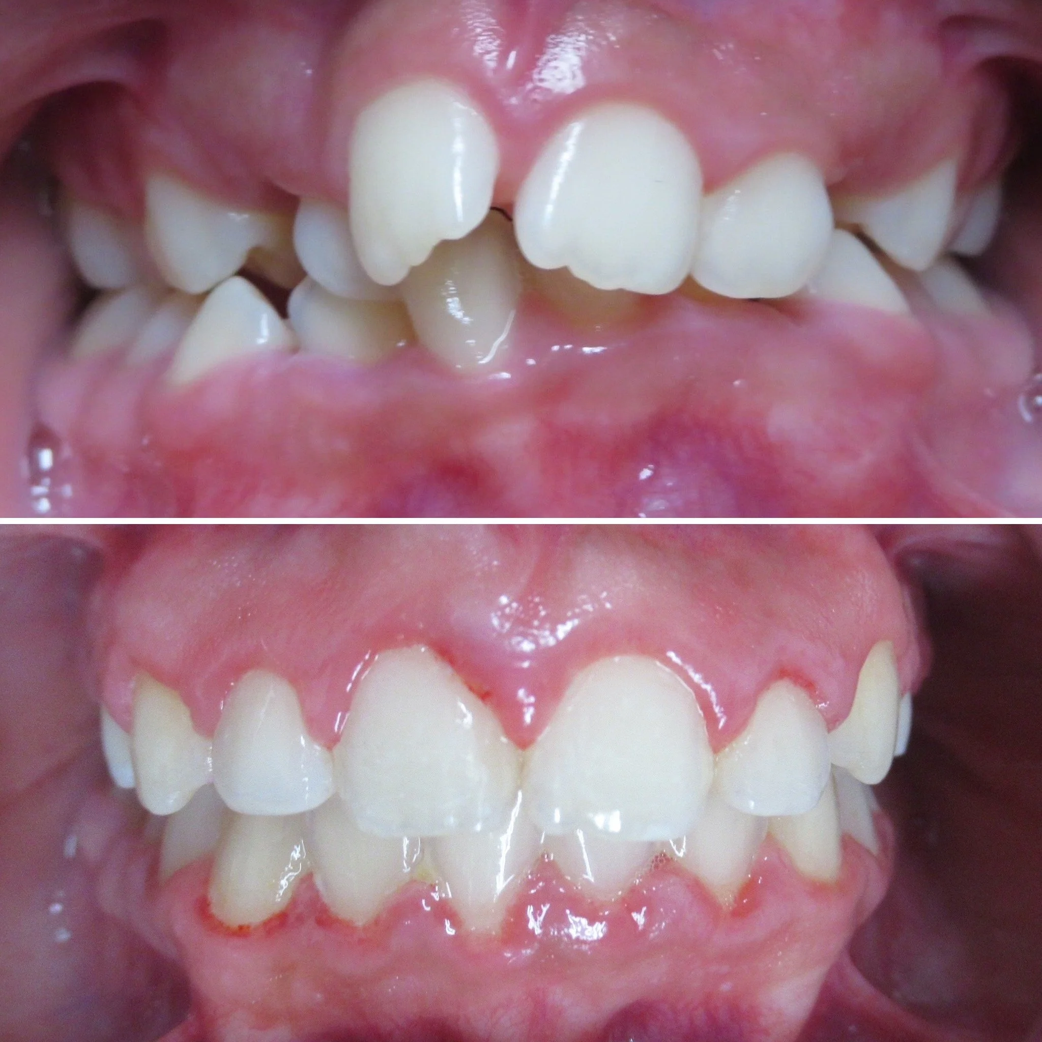 Before and after orthodontic treatment for a tooth that erupted out of position.
