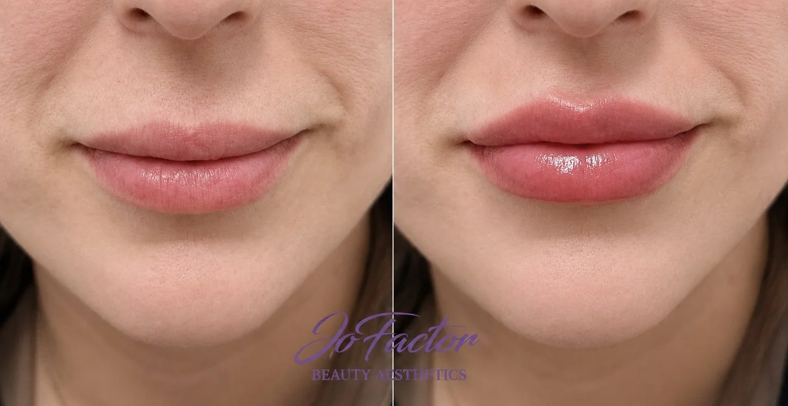 Close-up of a person's lips before and after cosmetic lip enhancement treatment, with the after lips appearing fuller and glossier.