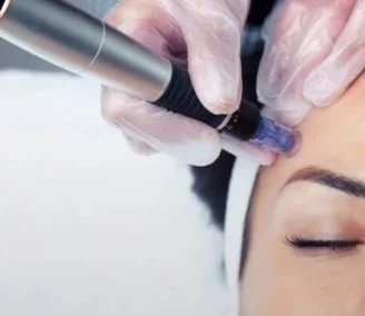 microneedling near me cosmetic acupuncture near me