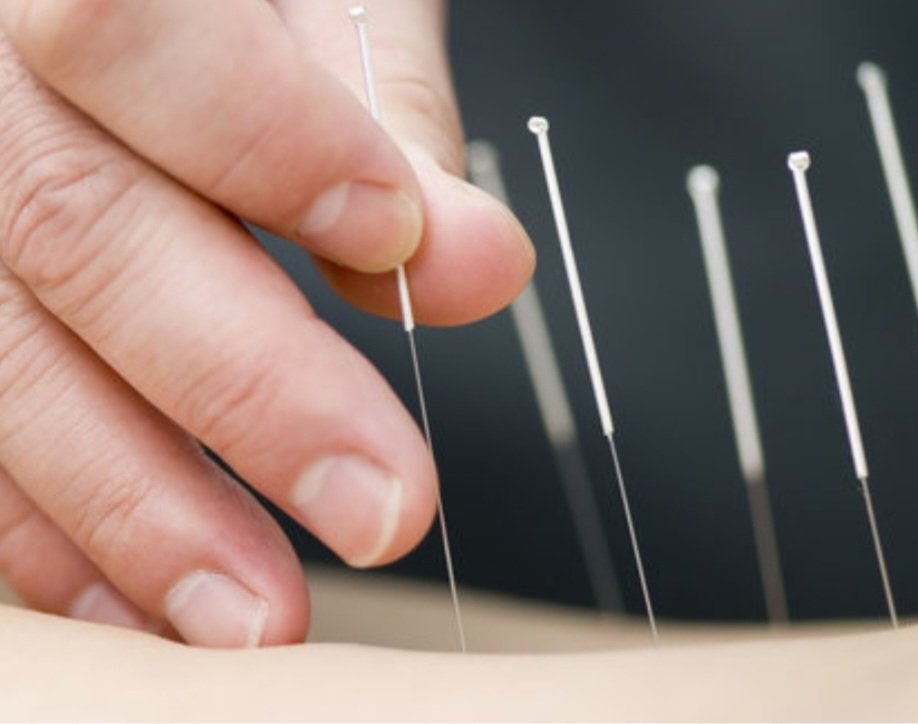 acupuncture near me