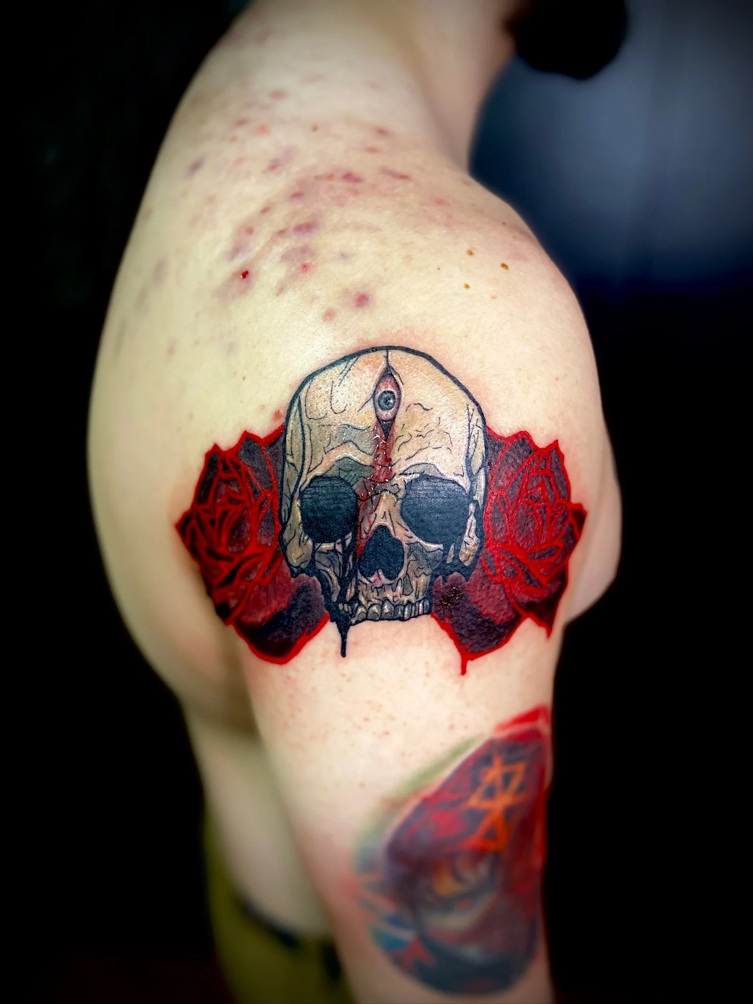 Tattoo of a skull with a circular eye, surrounded by red design, on person's arm with multiple red pimples and marks.