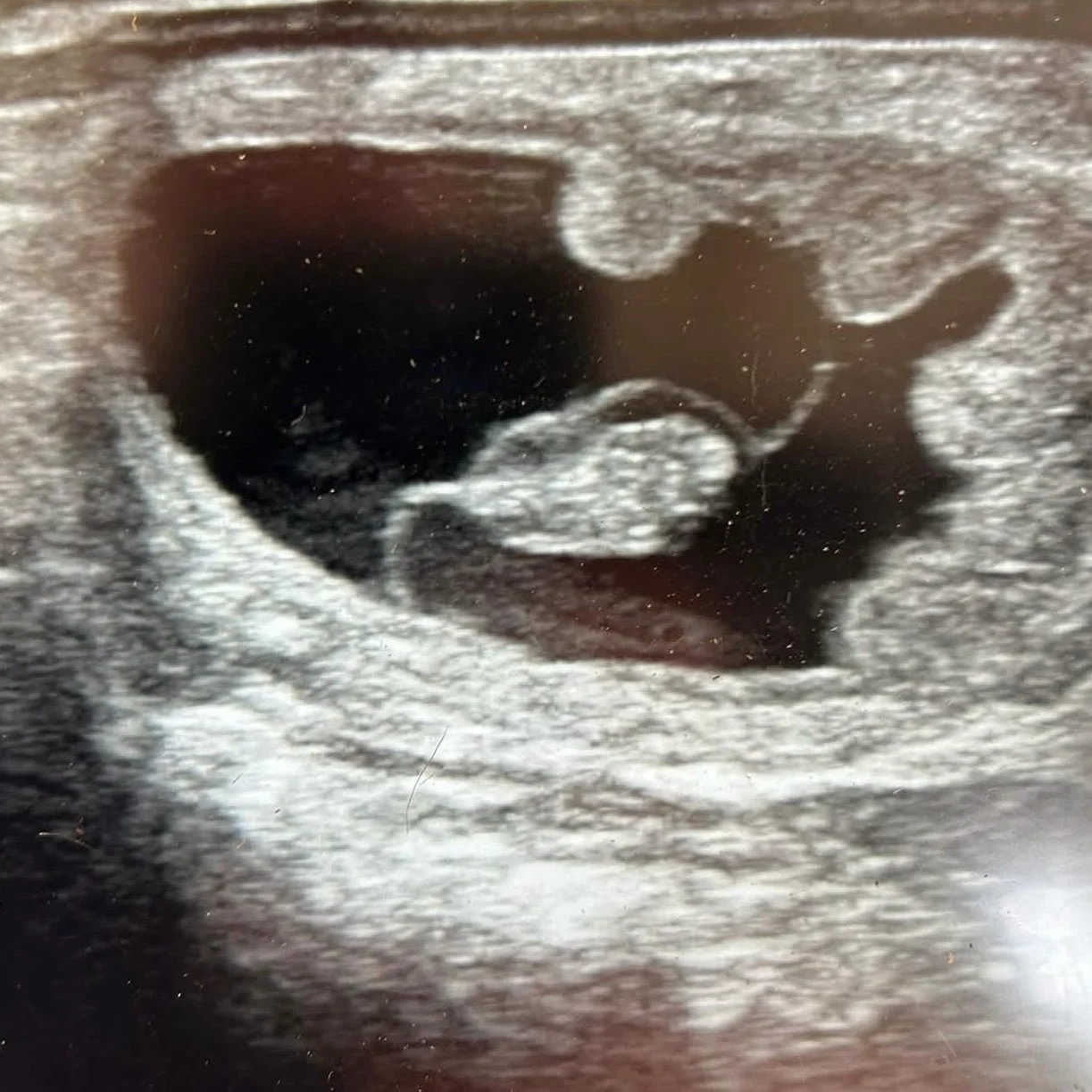 Ultrasound image showing a developing fetus in the womb.