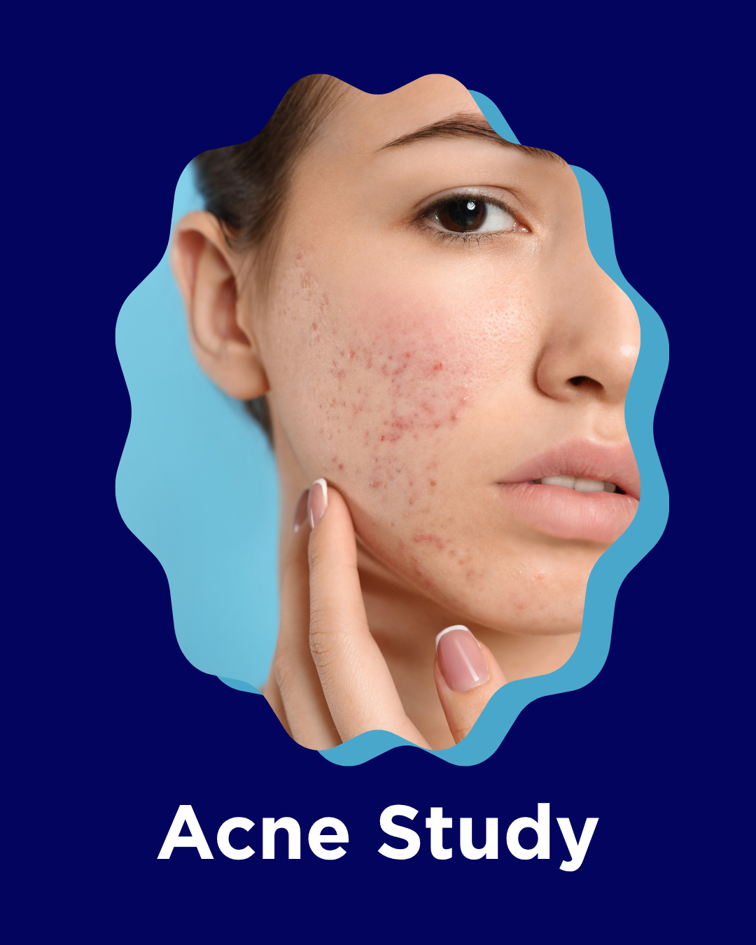 Close-up of a woman's face with acne, touching her cheek, with text 'Acne Study' at the bottom.