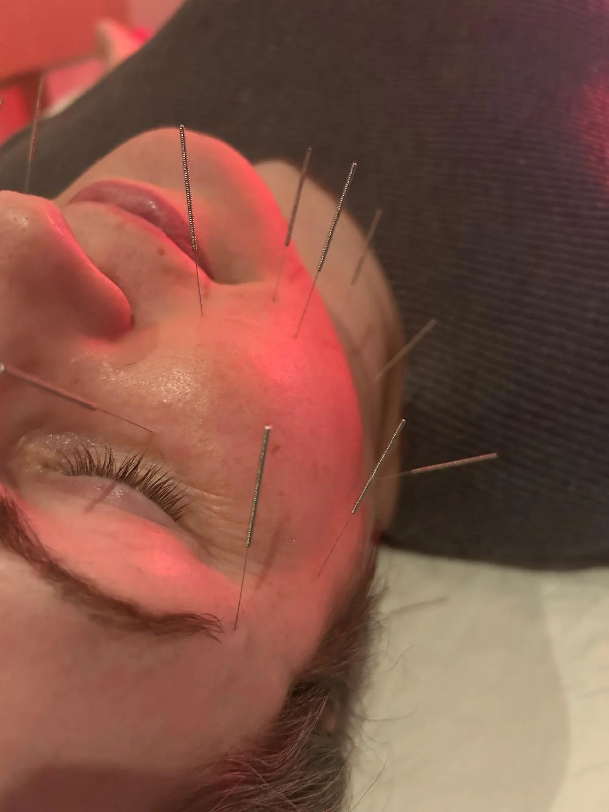 Holistic Facial Rejuvenation + Microneedling with Dr. Rachel Eni