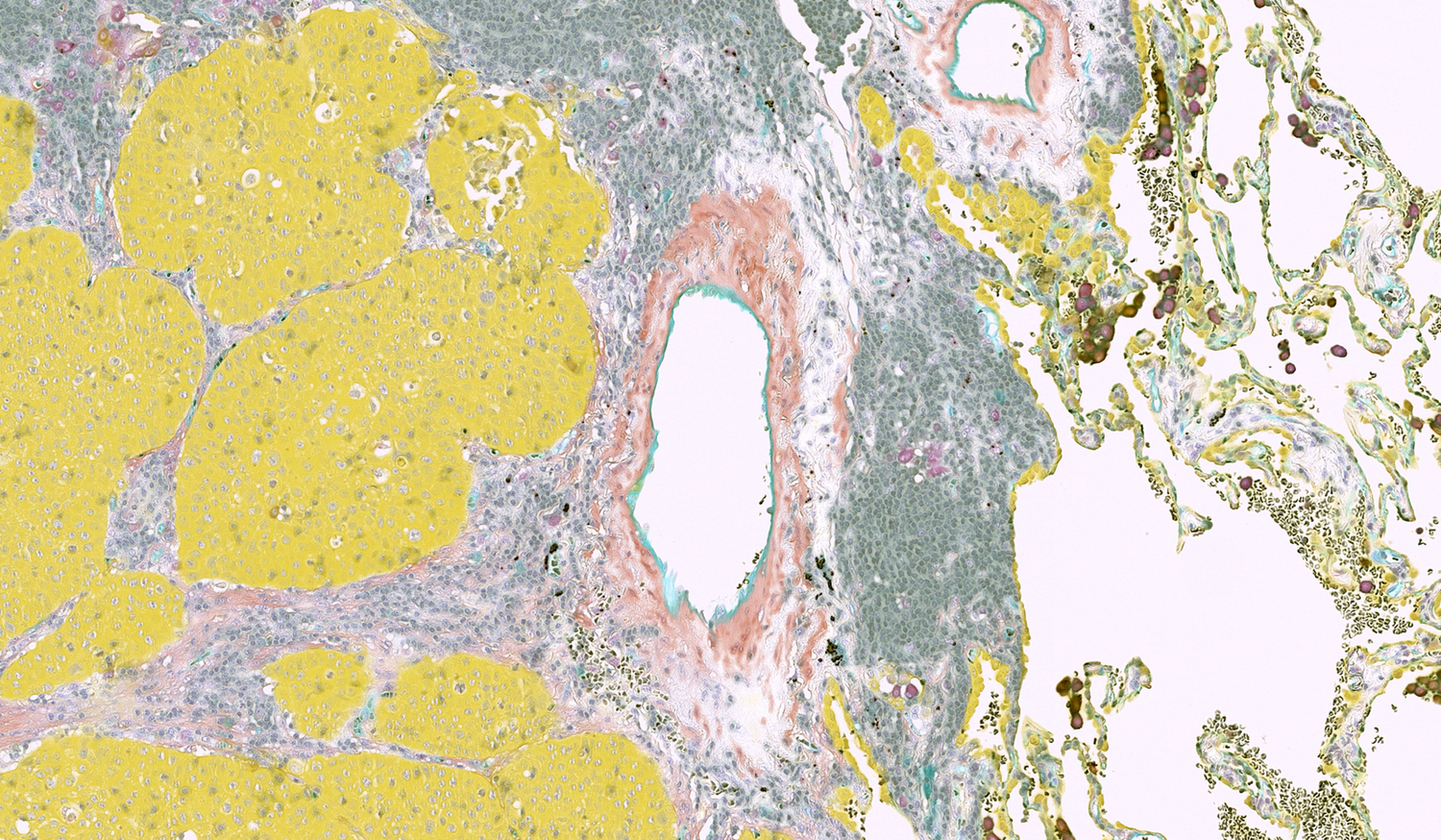Virtual multiplex IHC