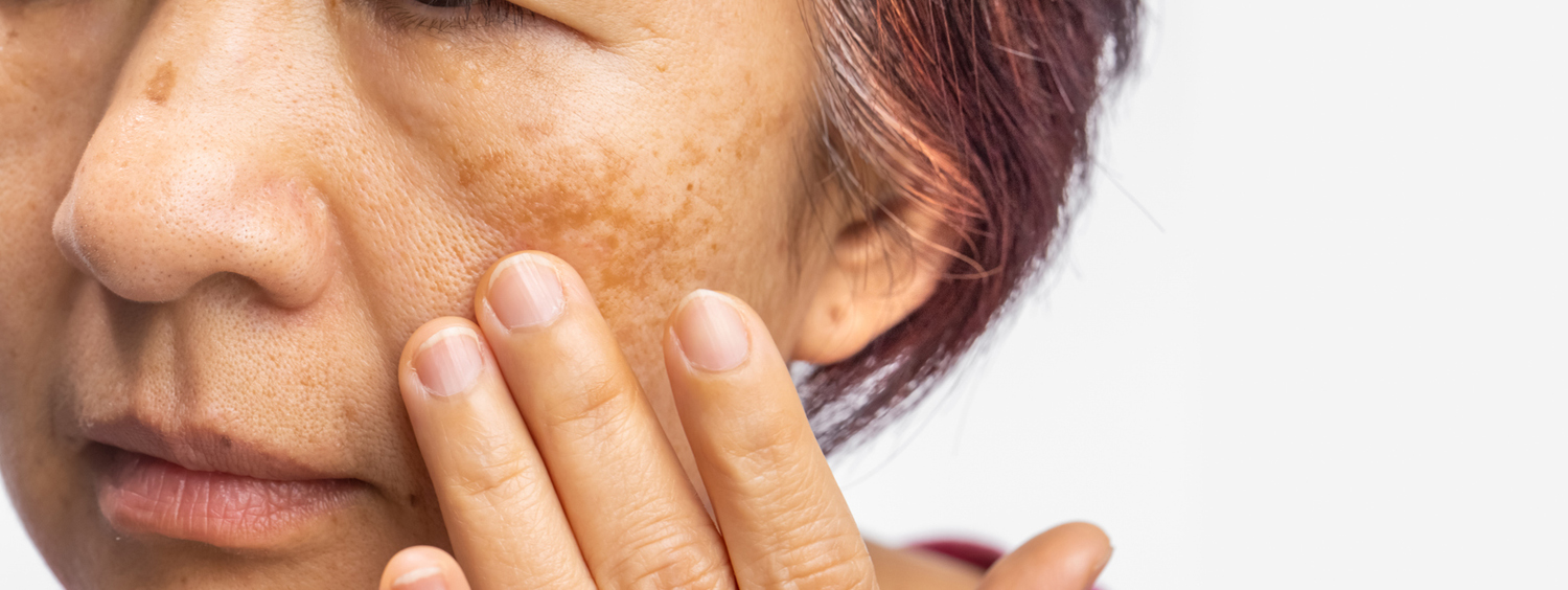 Menopausal woman worry about melasma on face.