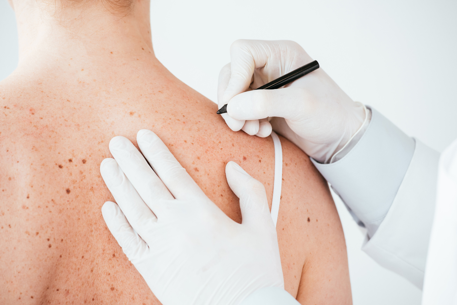 Doctor marking woman's shoulder with pen before surgery.
