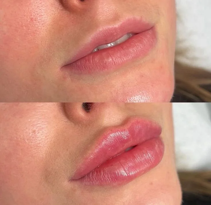 Close-up of a person's lips, showing a before and after of lip enhancement or gloss application.