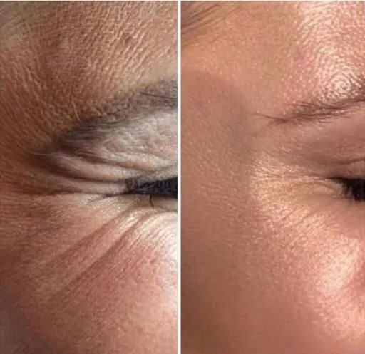 Close-up of a person's eye showing reduction in wrinkles around the eye area.