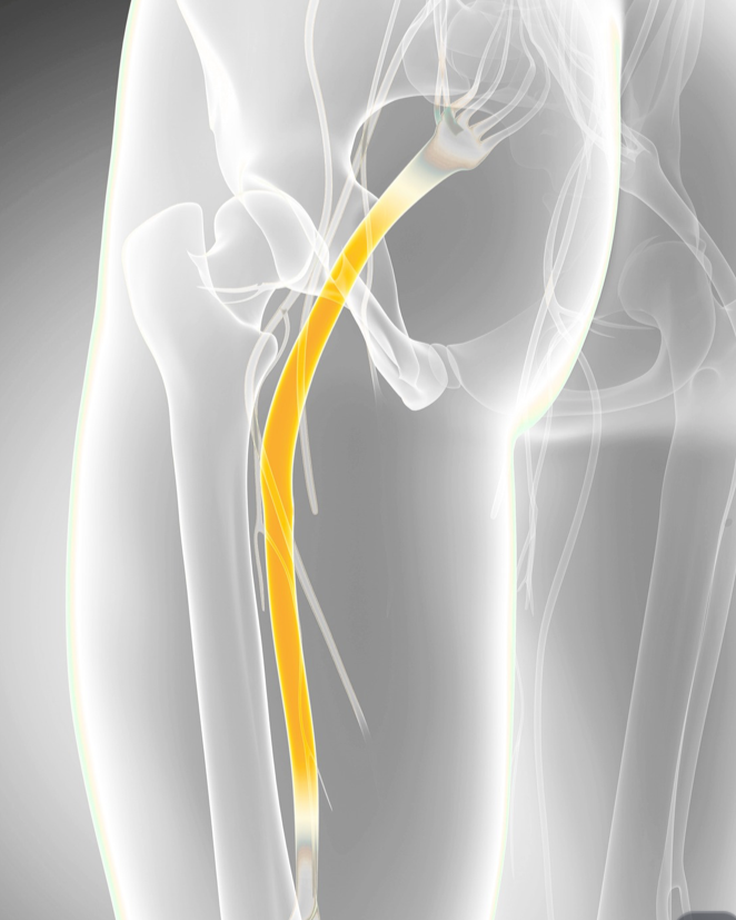 Medical illustration of a human thigh showing the sciatic nerve highlighted in yellow.