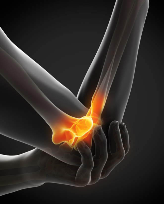 Medical illustration of an inflamed wrist joint showing pain or injury.