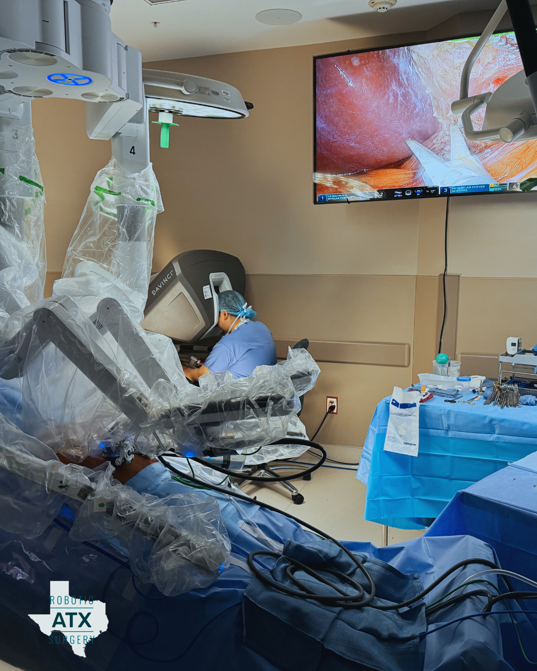 An operating room with a robotic surgical system, a surgeon in scrubs and a surgical monitor displaying a close-up of internal tissue.