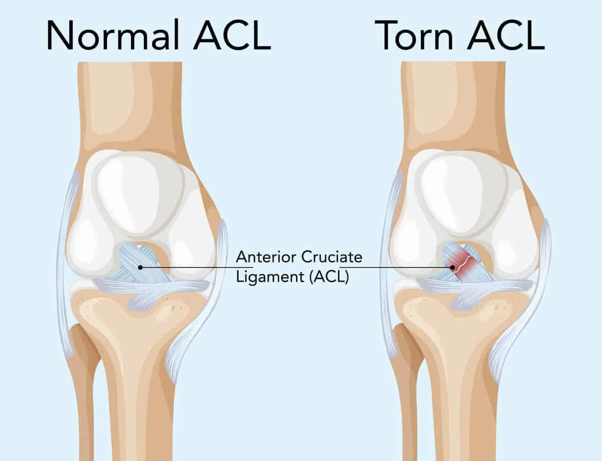ACL-tear-1.jpg