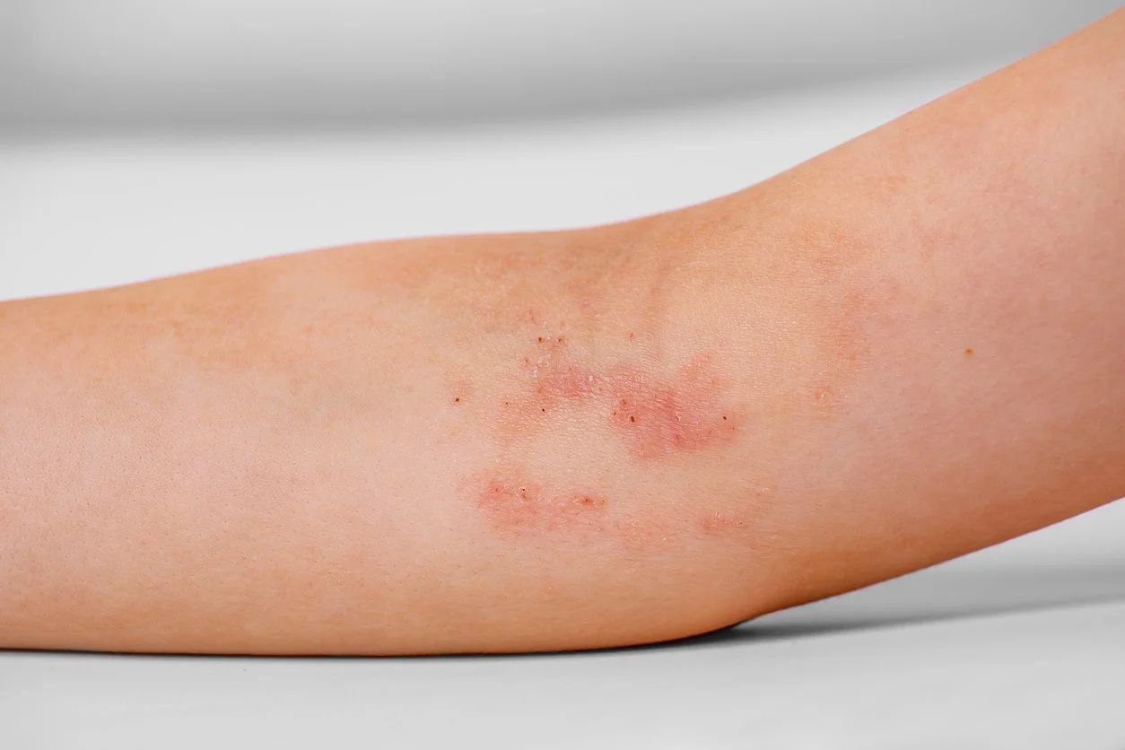 Nahaufnahme eines menschlichen Arms mit juckender, gereizter Haut, Rötungen und kleinen Wunden.