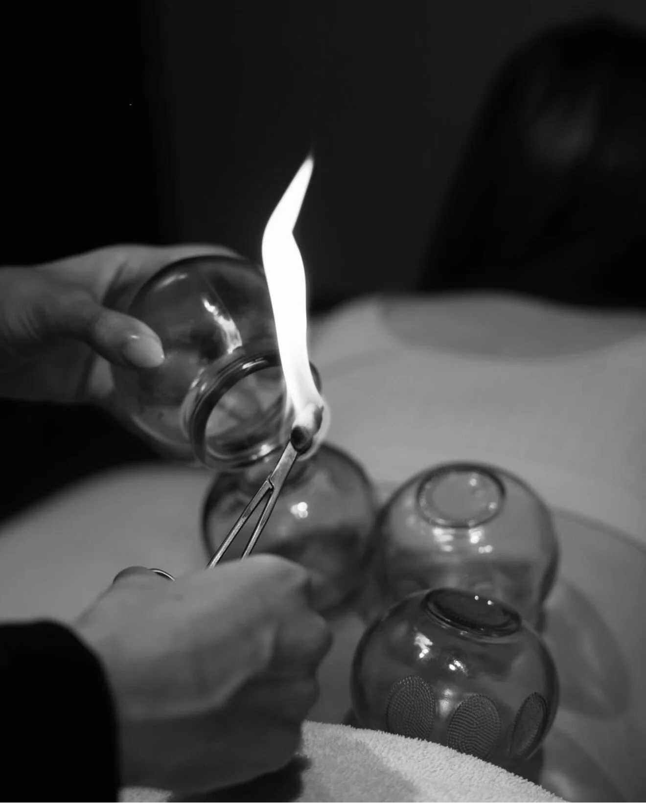 Cupping and dry needling used during occupational therapy treatment.
