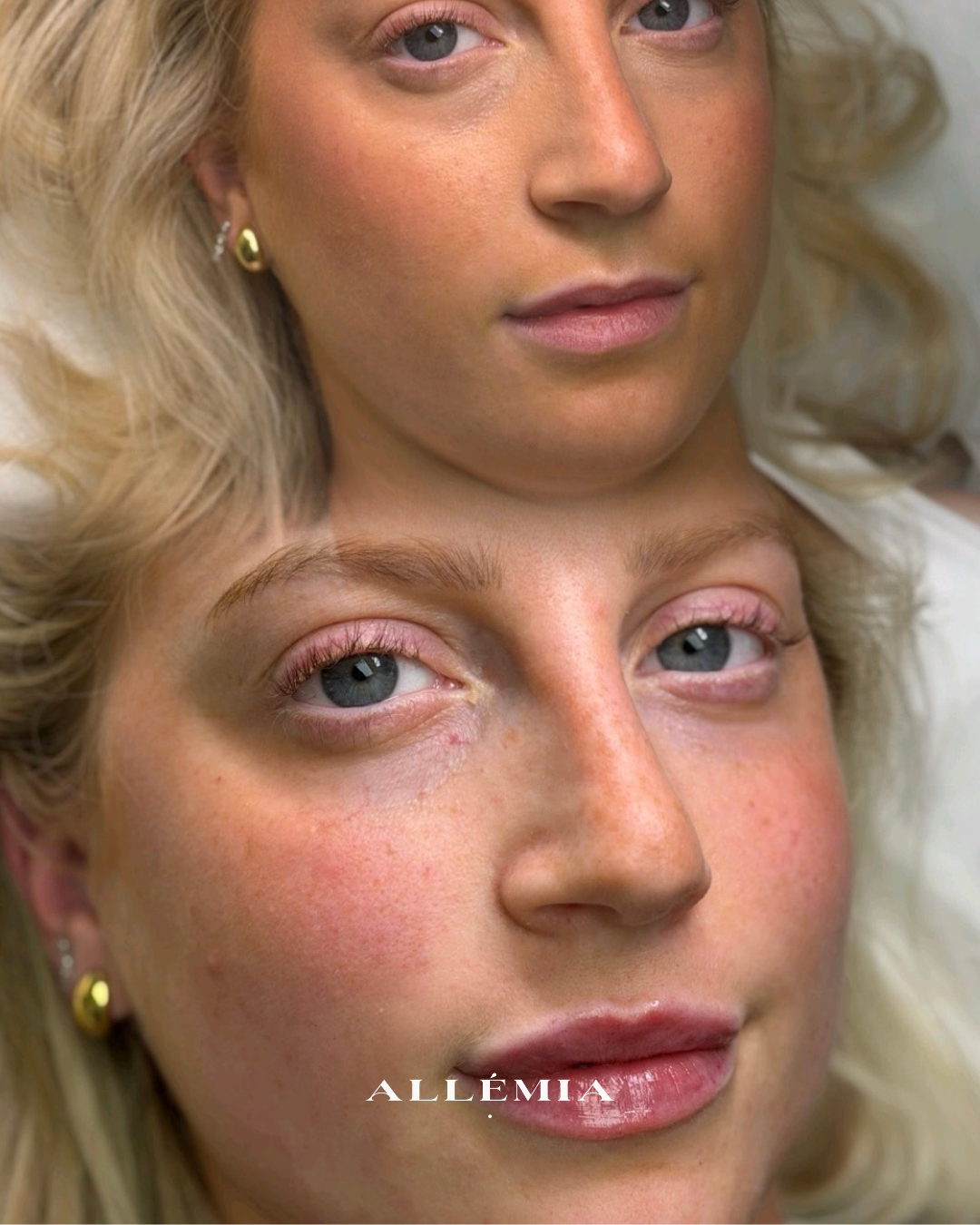 Lip filler