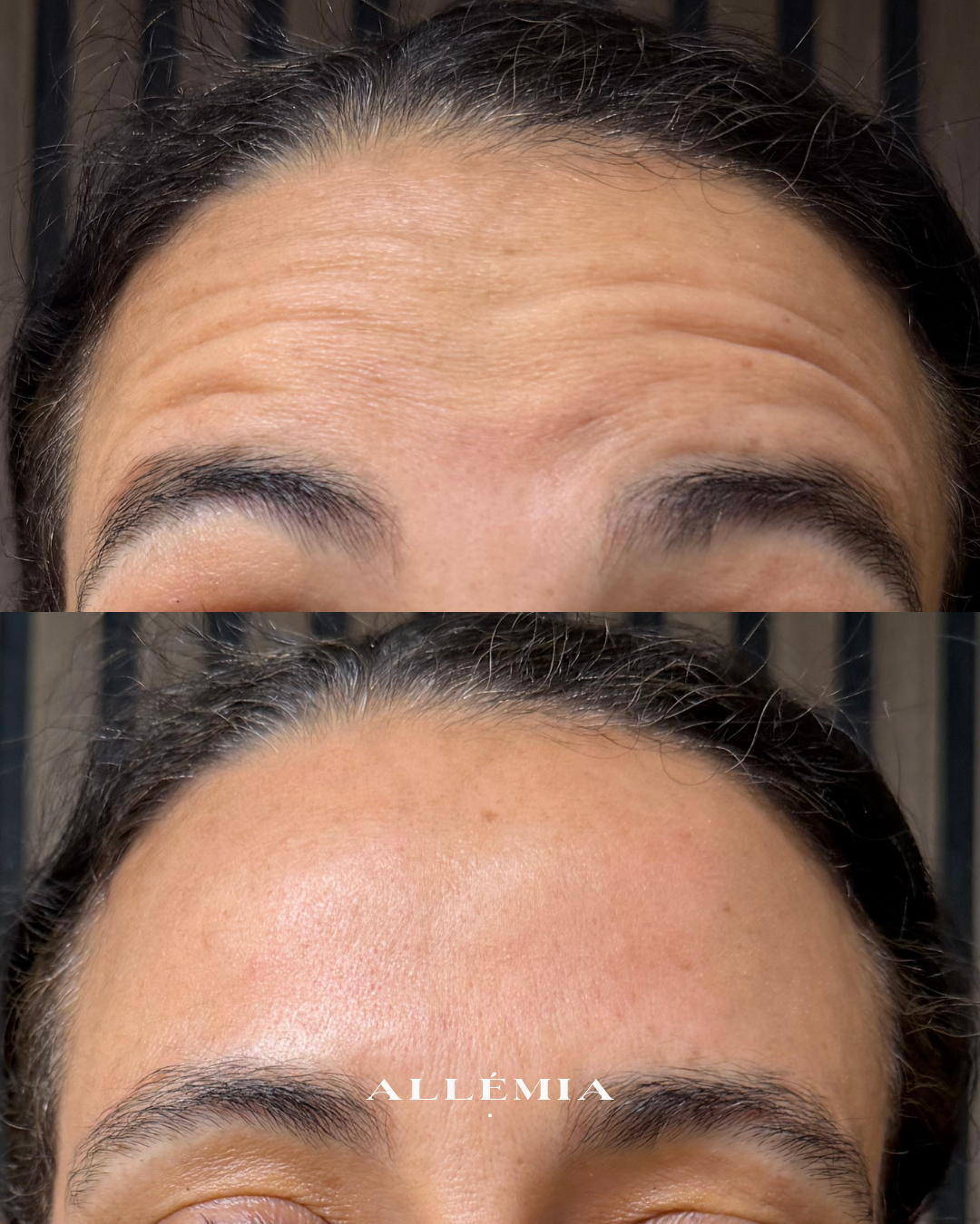 Anti-wrinkle injections