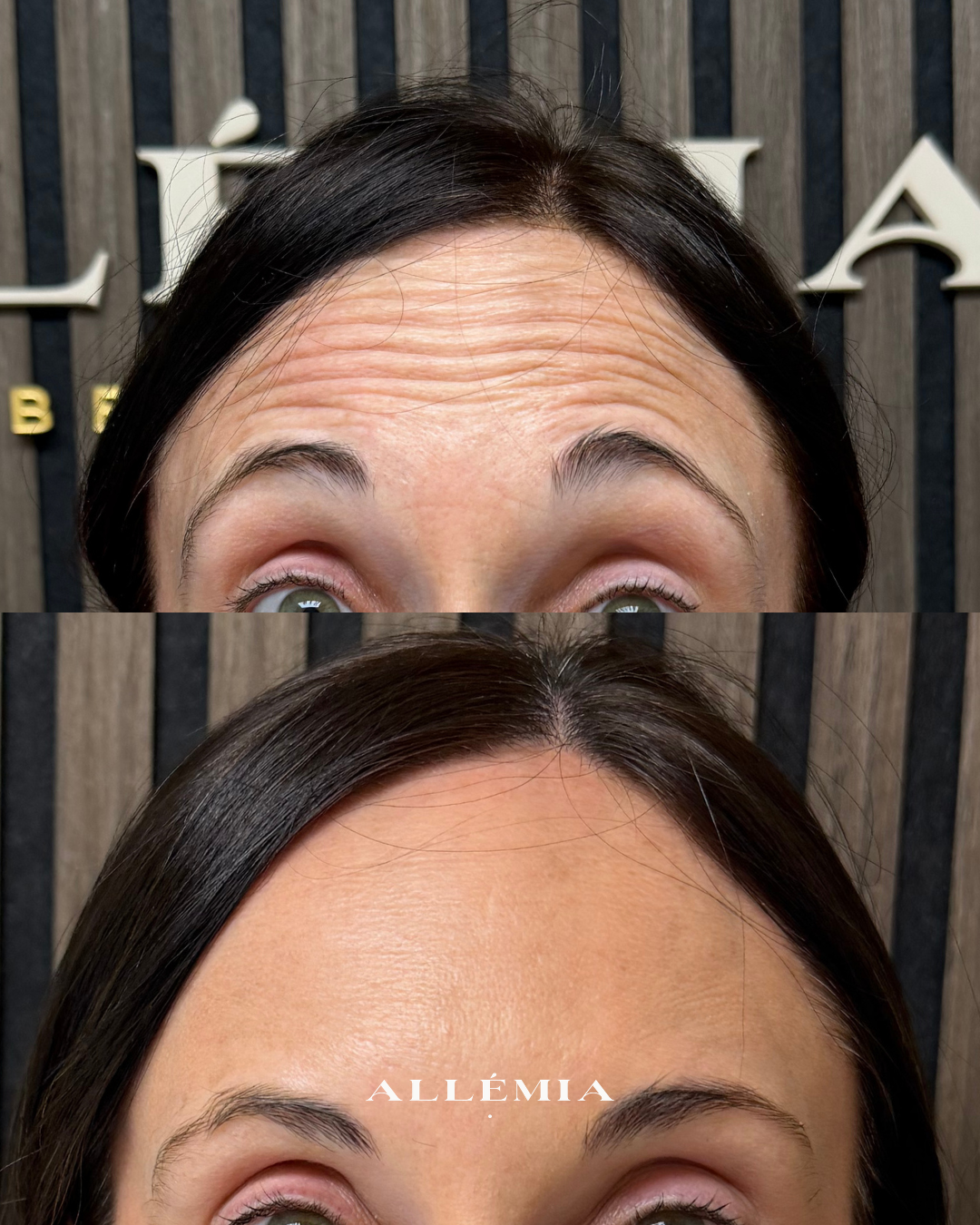 Anti-wrinkle injections