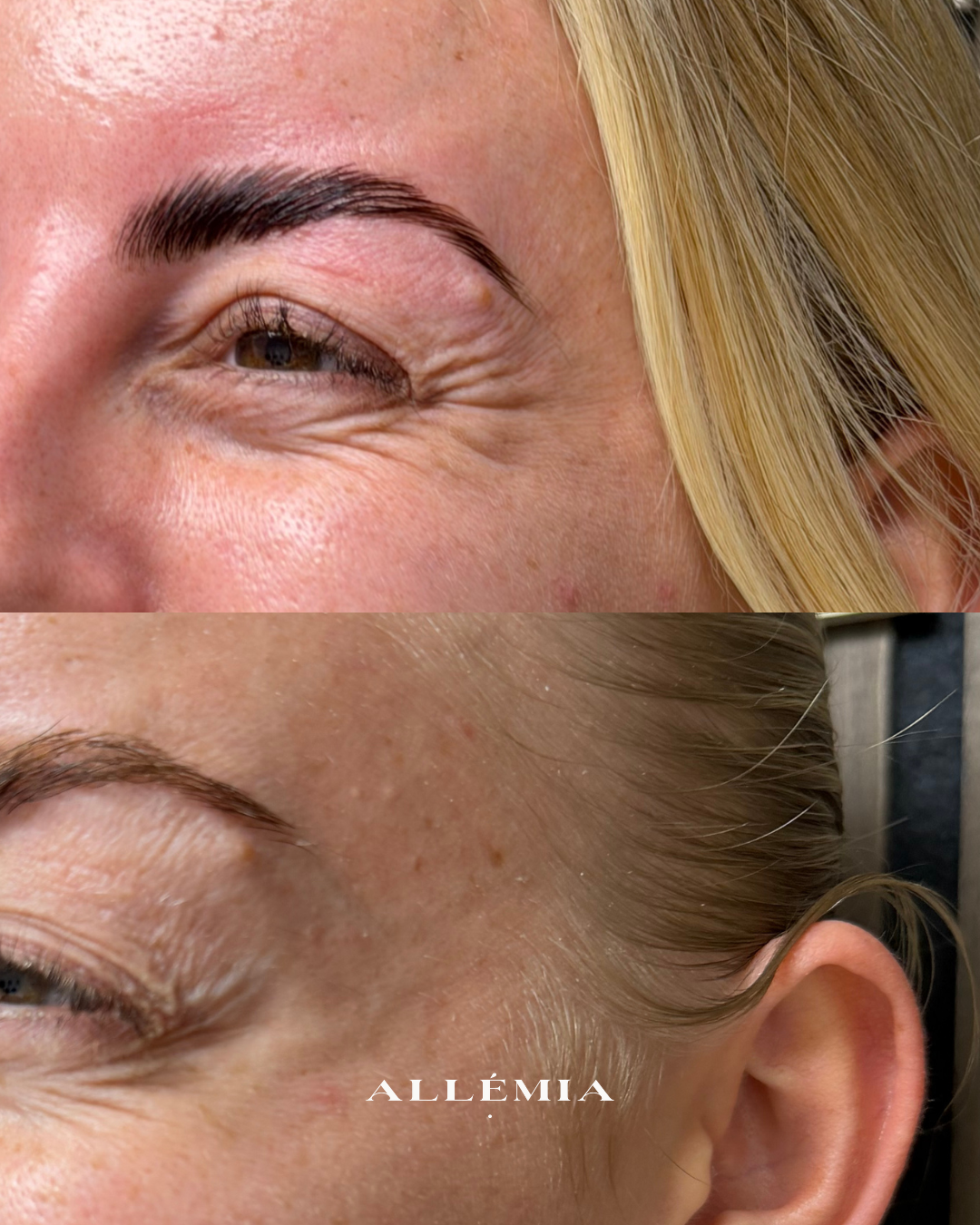 Anti-wrinkle injections