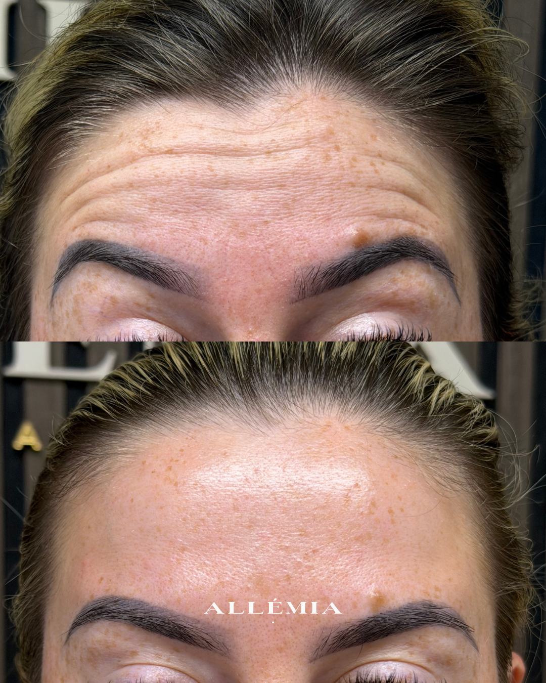 Close-up of a woman's forehead before and after skincare or cosmetic treatment, showing reduced wrinkles and smoother skin.