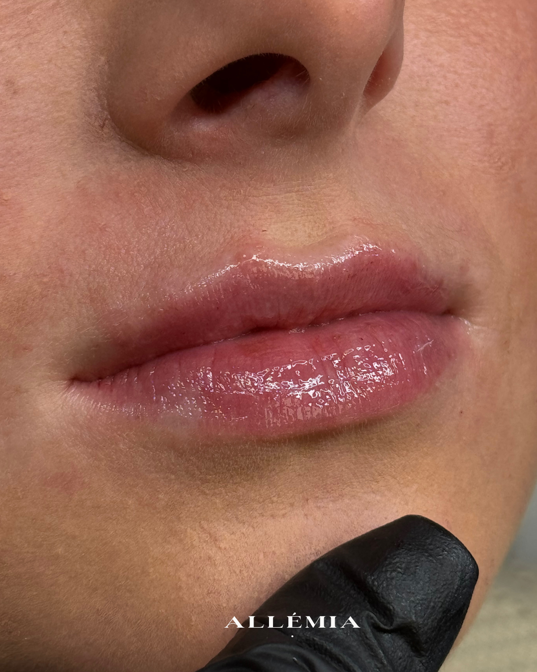Lip filler