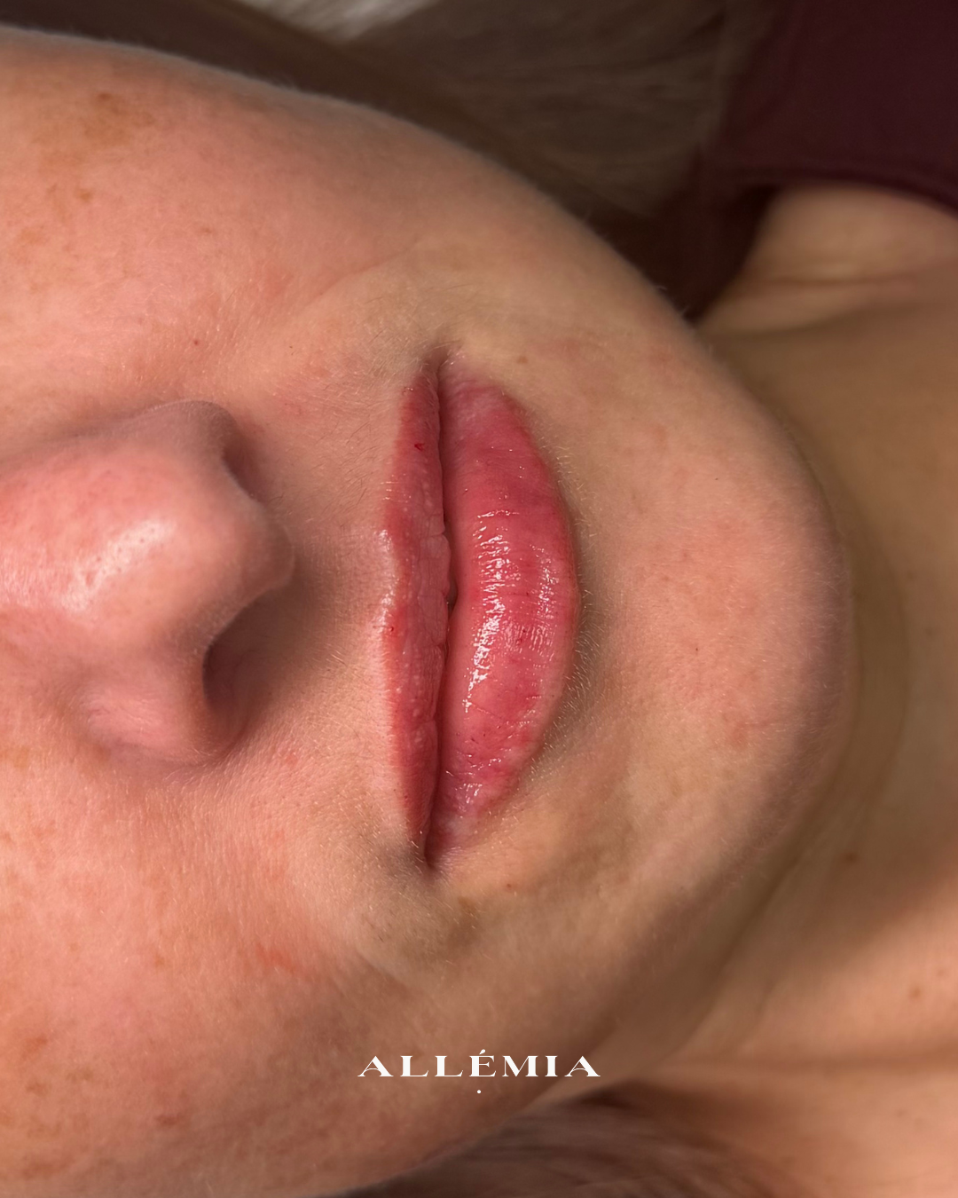 Lip filler