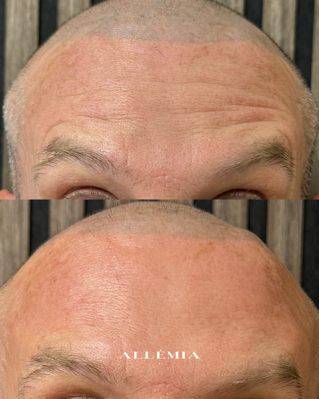 Anti-wrinkle injections
