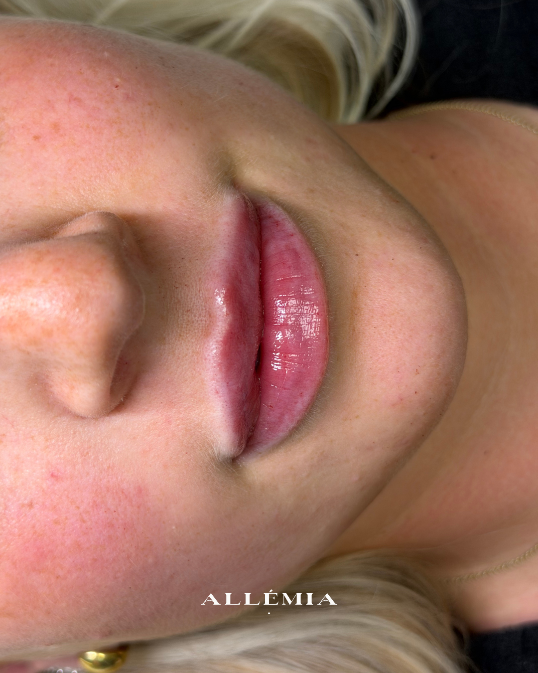 Lip filler