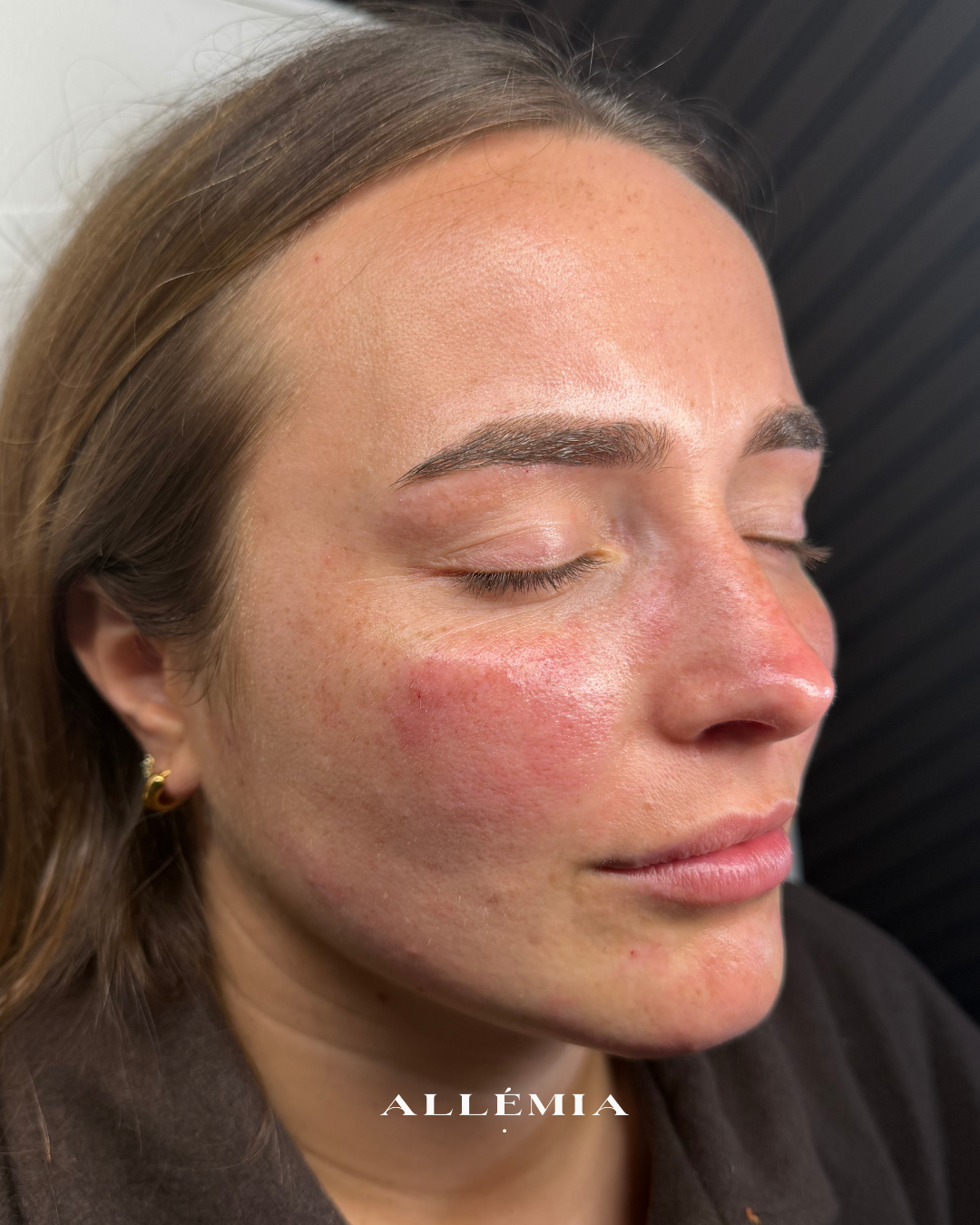 Close-up of a woman's face with her eyes closed, showing red and irritated skin on her cheek and nose, with some visible freckles and light makeup.