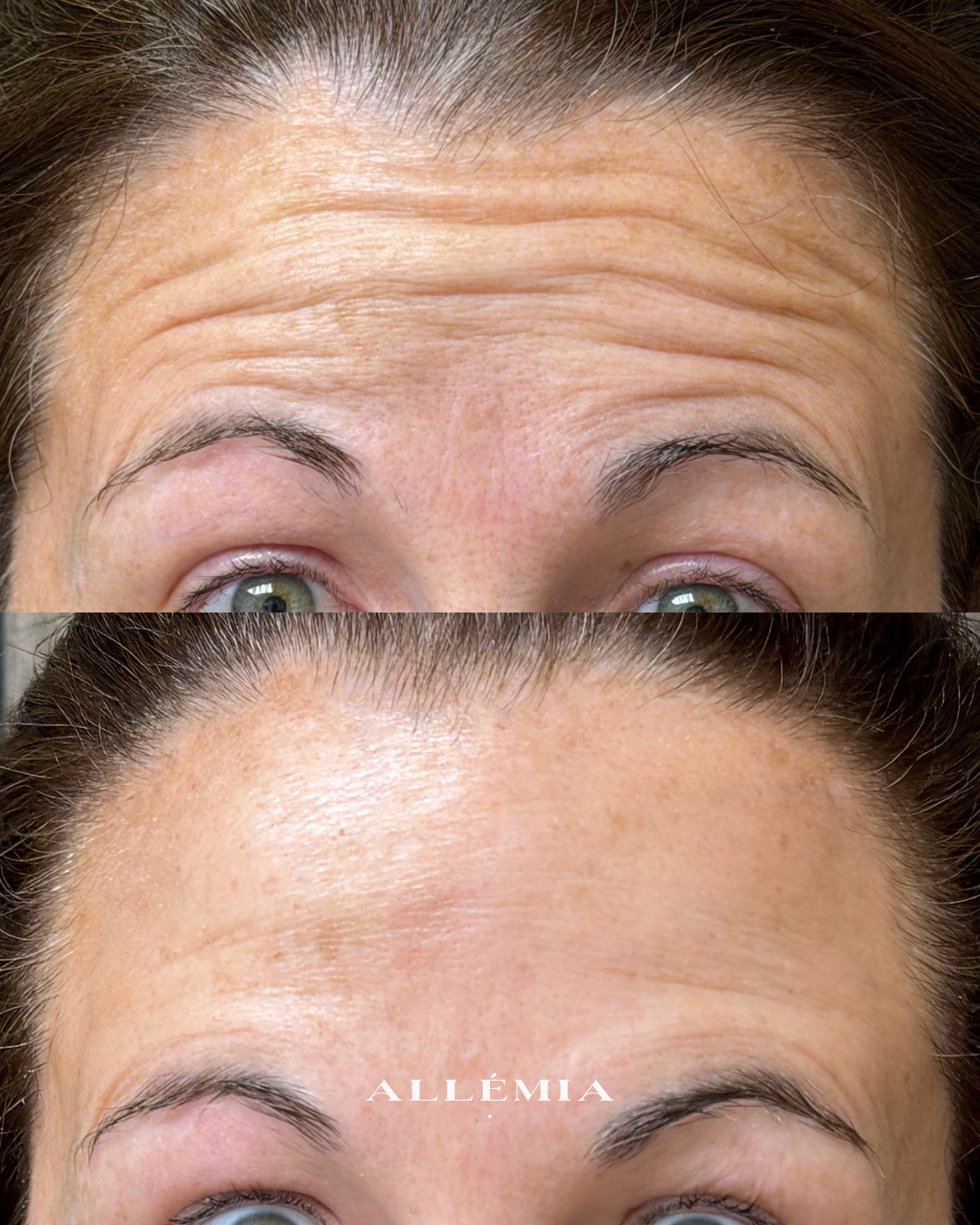 Anti-wrinkle injections