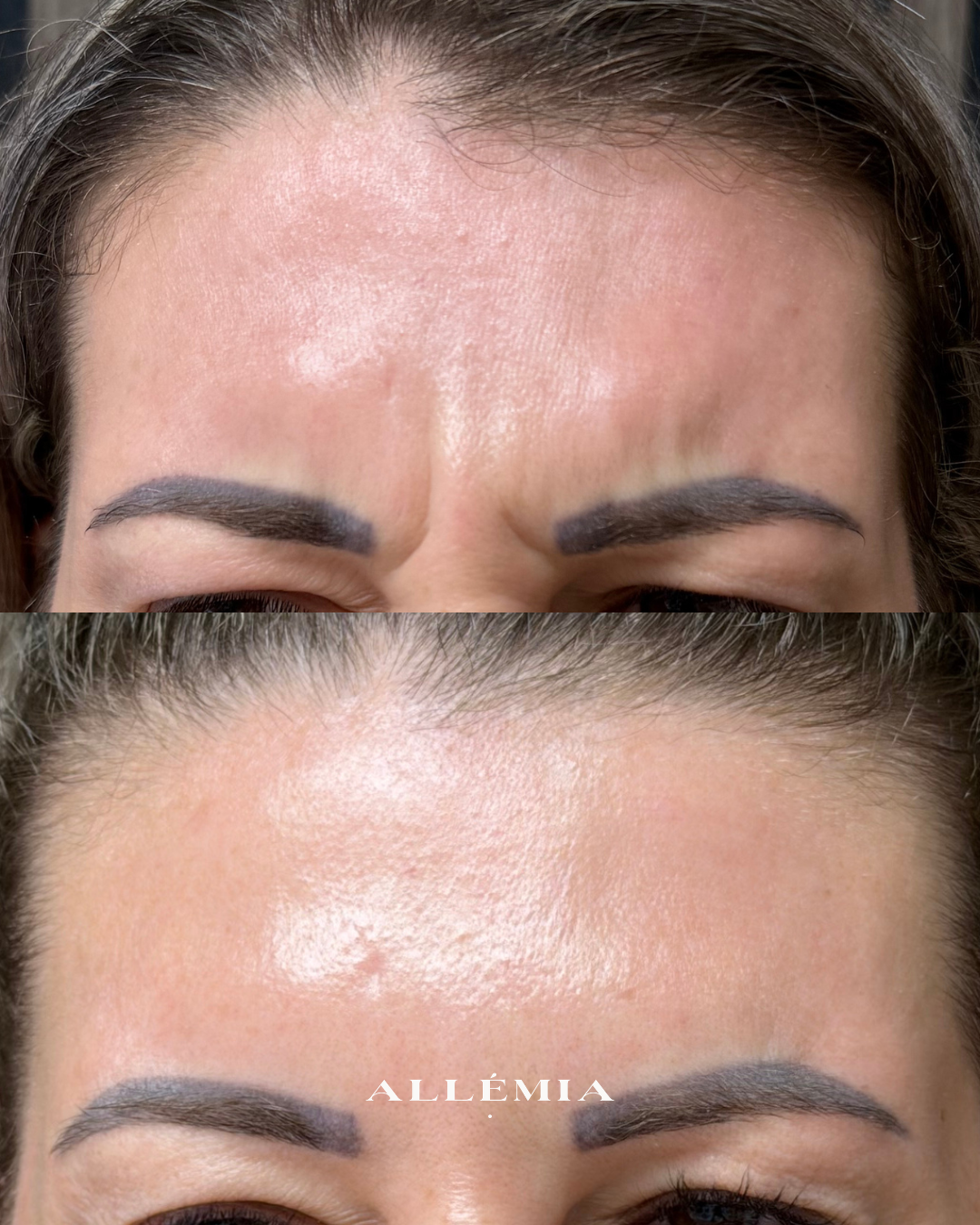 Anti-wrinkle injections